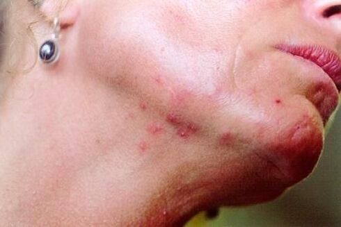 redness of the skin due to worms