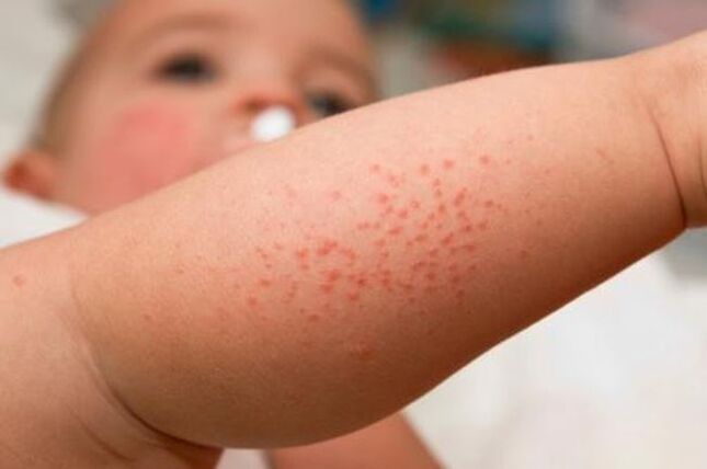 skin rash due to parasites