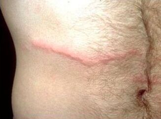 How to get rid of subcutaneous parasites in people