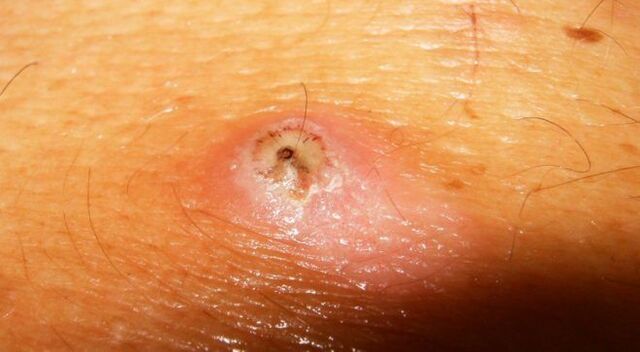 parasites under human skin