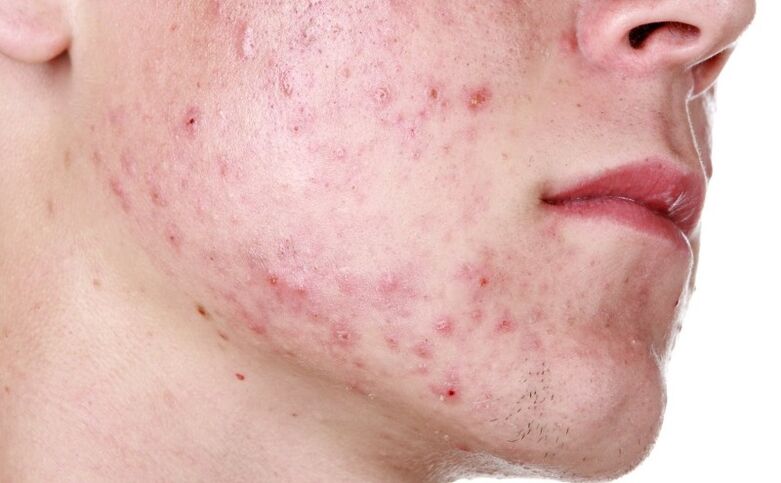 facial rash caused by parasites