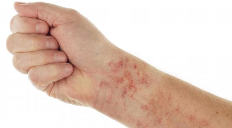 skin rash in the presence of parasites in the body